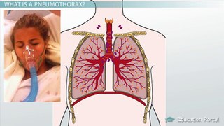Pneumothorax and Atelectasis: Similarities, Differences & Causes