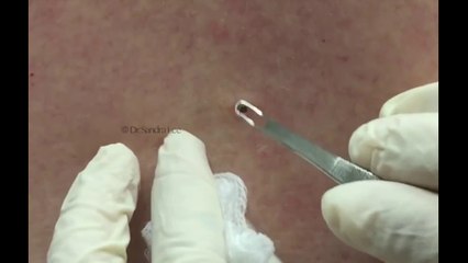 Usando o tirador de espinha