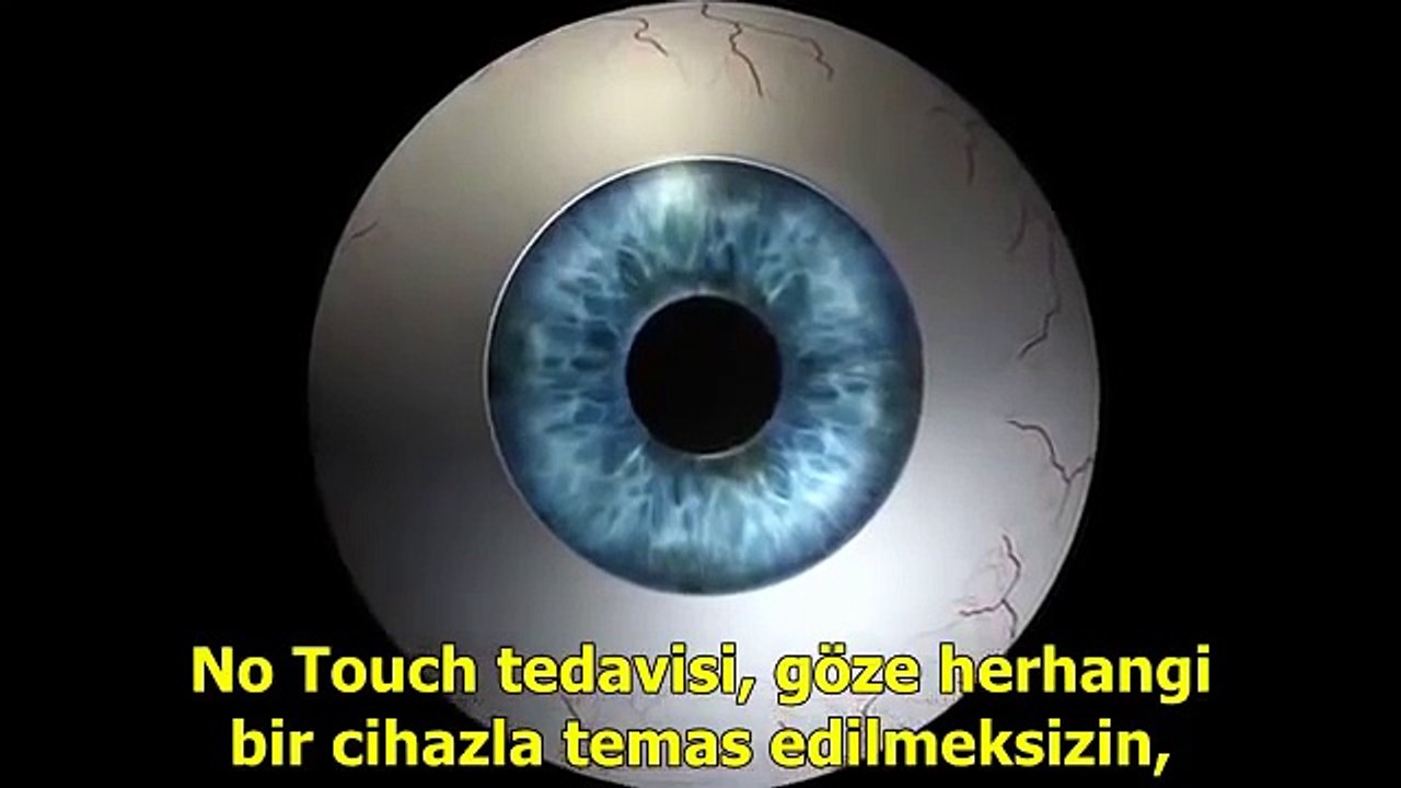 TransPRK No Touch Surface Treatment with SCHWIND AMARIS Laser Systems TR