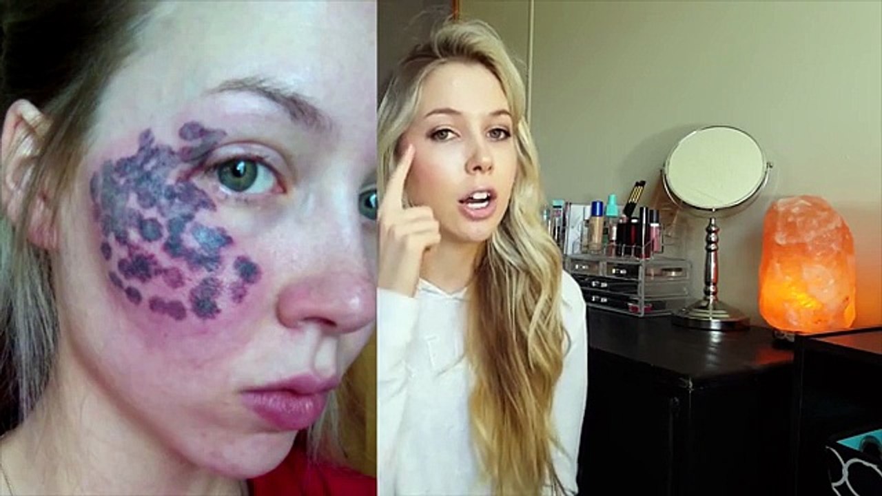 Elle se fait opérer au laser pour retirer cette tache de naissance, mais ce qui arrive à son visage OH MON DIEU!