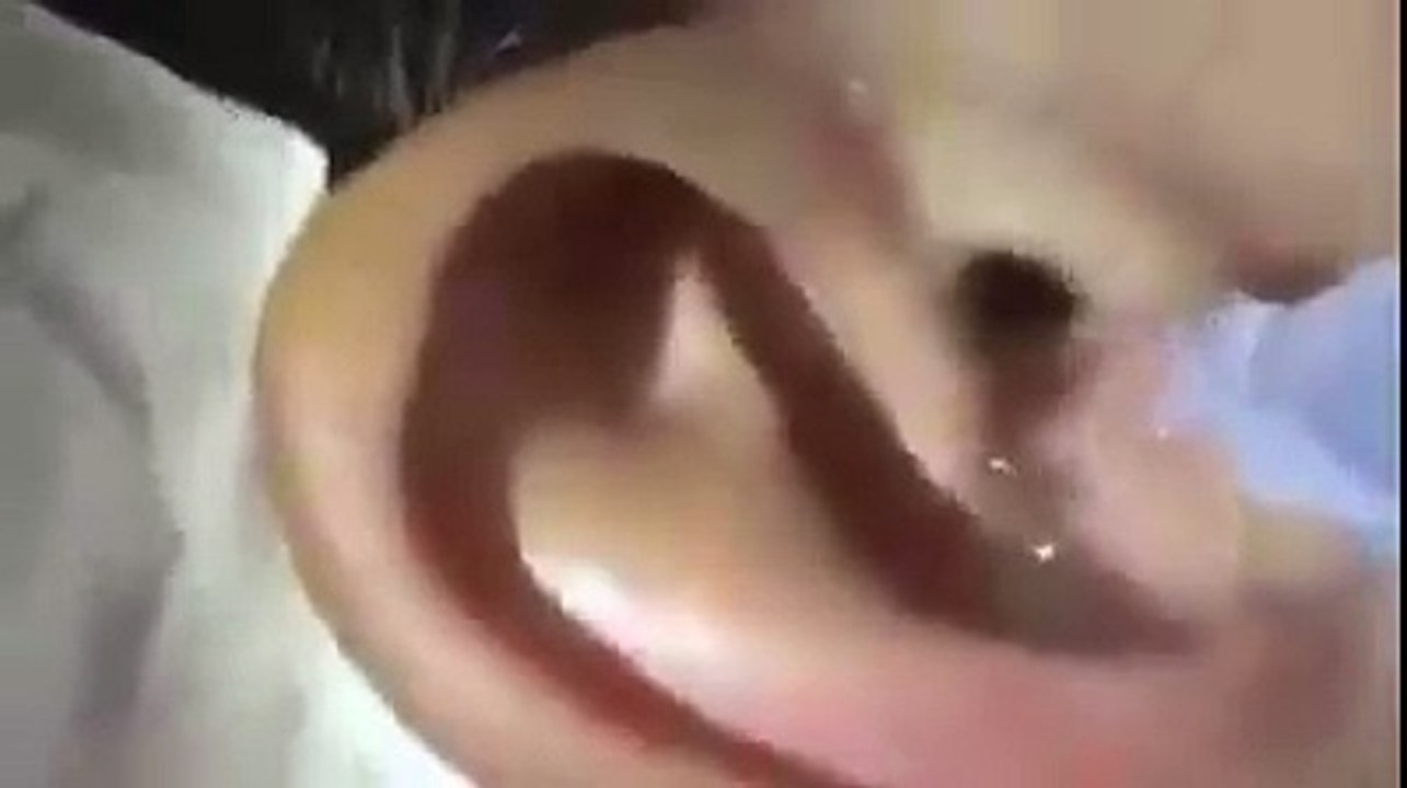 شاهد كيفية اخراج حشرة كبيرة من الأدن