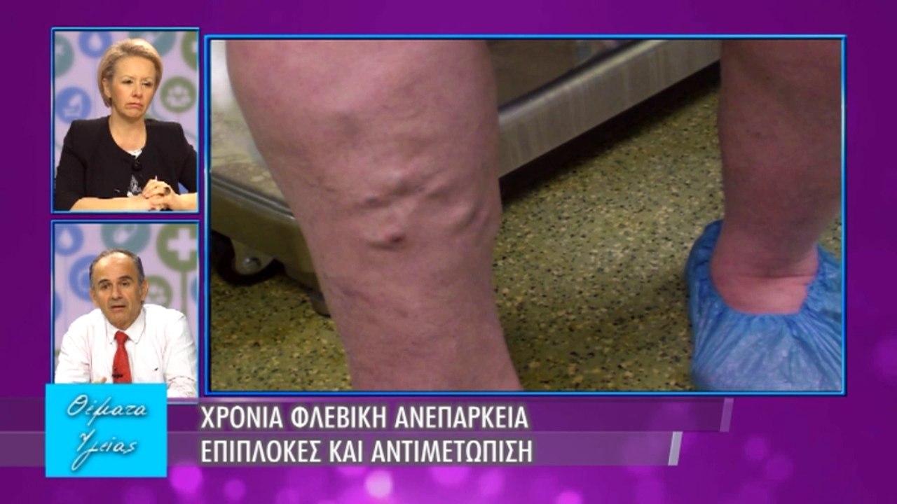 Υγείας Θέματα - Εκπομπή 16 - Φλεβική Ανεπάρκεια - Β' μέρος