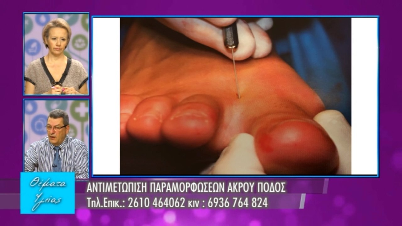 Υγείας Θέματα - Εκπομπή 17 - Παθήσεις άκρου ποδός - Β' μέρος