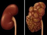 Polycystic kidney syndrome(PKD)