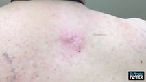 HD DILATED PORE OF WINER AND BLACKHEADS ON THE BACK - New.mp4