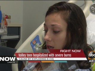 Valley teen hospitalized with severe burns
