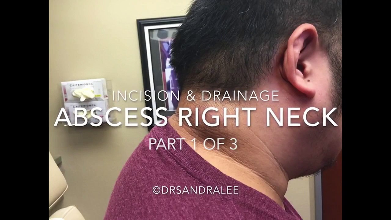 Hilton method for abscess (Incision & Drainage) (Subcutaneous) تفجير ...