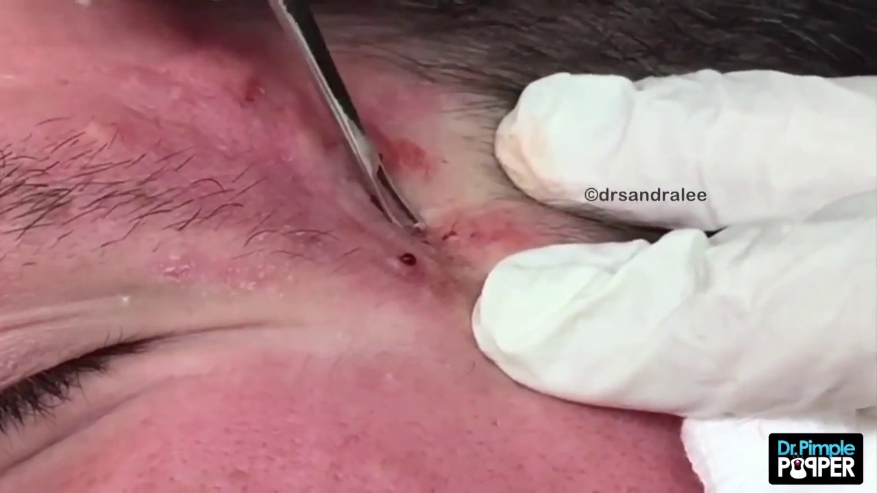 Popular Videos - Acne vulgaris