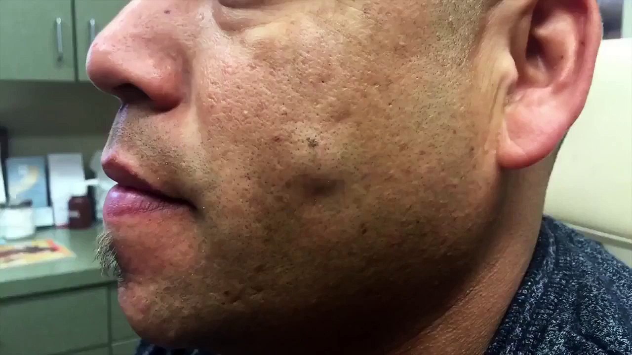 cysts boils blackheads lipomas Dailymotion Video