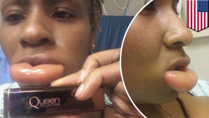 Allergic reaction to CoverGirl lipstick leaves woman with huge swollen lip