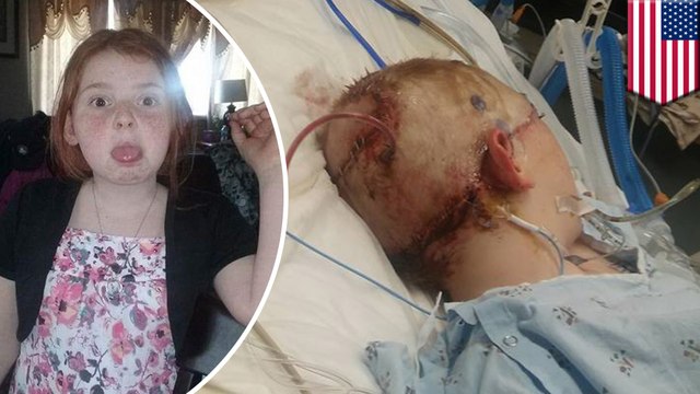 Horror as girl's entire scalp torn clean from her head as hair gets caught in carnival ride