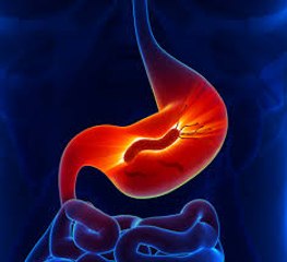 Stomach Ulcers