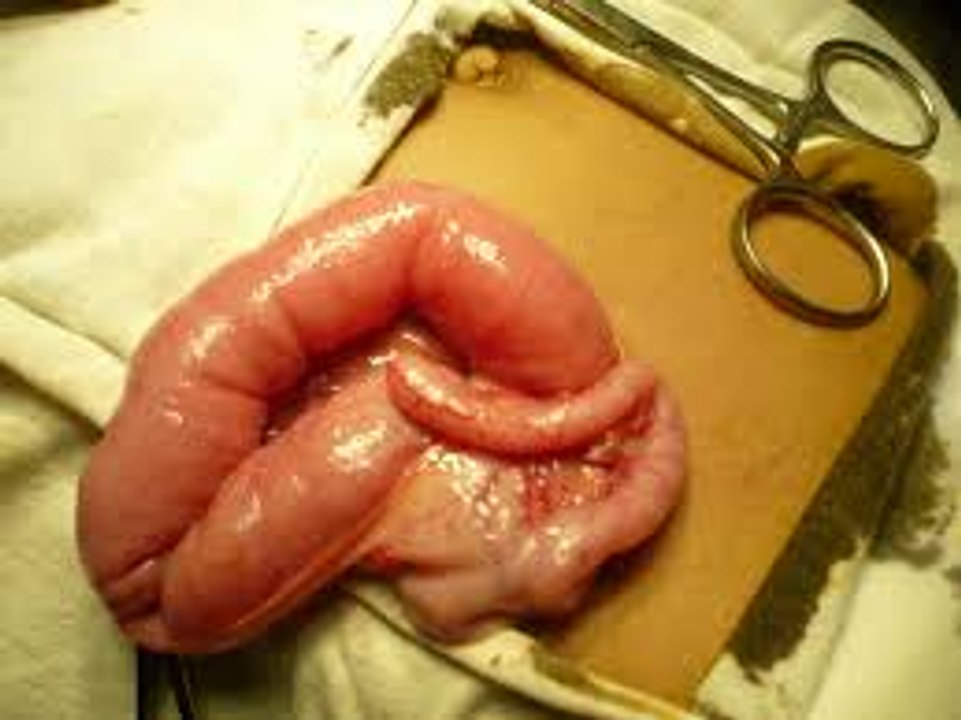 Appendicitis