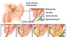 Nam giới không biết mình bị phì đại tuyến tiền liệt