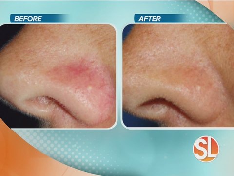 Get your legs ready for summer with spider veins treatment at Vein Med Solutions