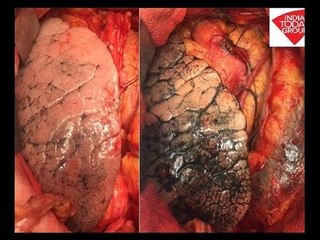 Delhi resident's lungs are not healthy instead of rural people!
