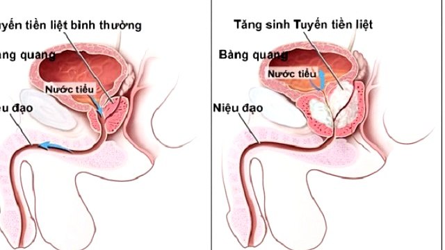 Những bệnh liên quan đến tuyến tiền liệt