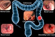 Colorectal Cancer: Causes, Symptoms and Treatments