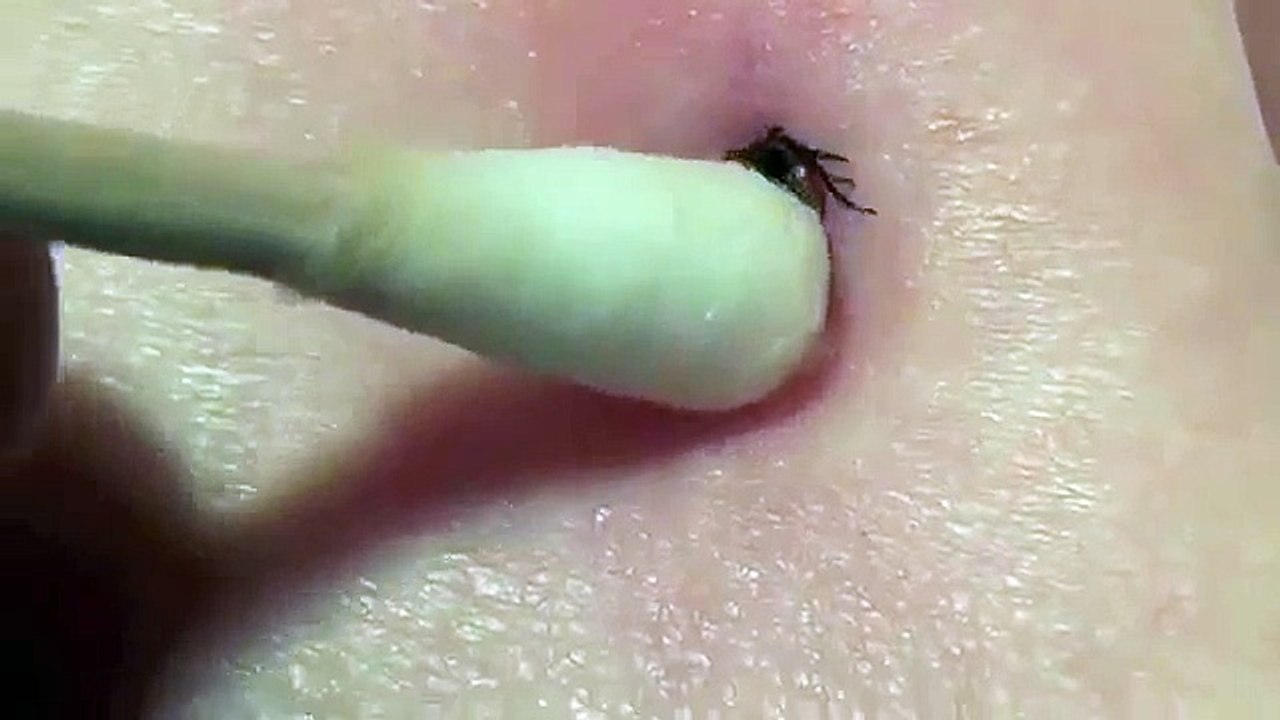 Voici une astuce qui vous permet de retirer une tique sur votre peau en toute sécurité !