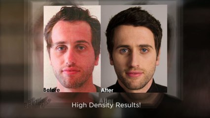 Hair Restoration Los Angeles FUE Hair Transplant in Los Angeles