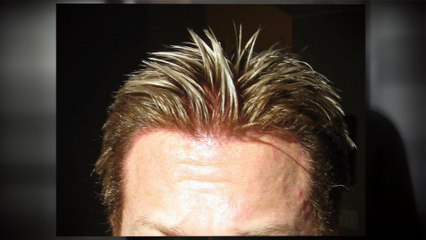 Hair Transplant Los Angeles FUE Hair Transplant in Los Angeles - Alvi Armani