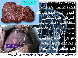 Le cancer du foie - carcinome hépatocellulaire GASTRO CASA