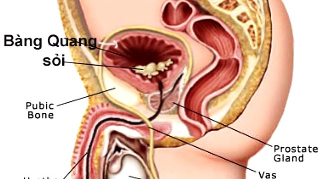phòng chống bệnh viêm tuyến tiền liệt