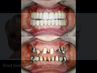 Bend implant dentistry
