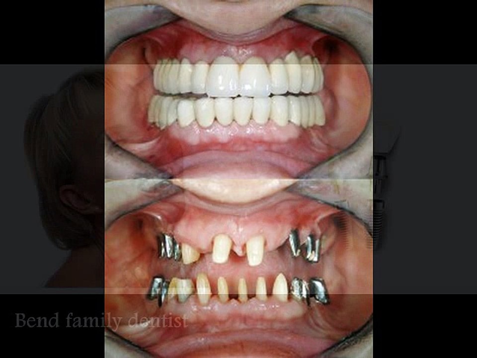 Bend implant dentistry