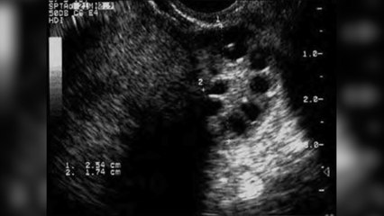 What is polycystic ovarian syndrome?