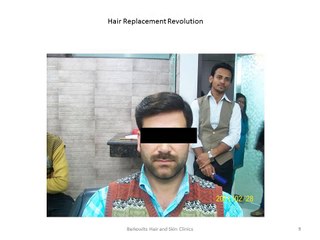 Best Hair Replacement Clinic in Delhi