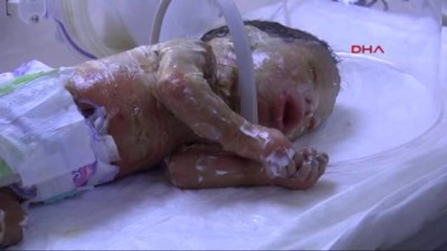 'Palyaço Bebek' Yaşam Mücadelesi Veriyor