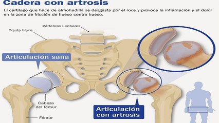 Prótesis de 'resurfacing' para la cadera