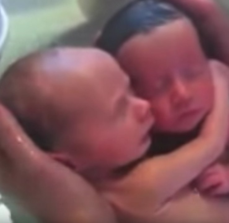 Baby twins refuse to be separated.