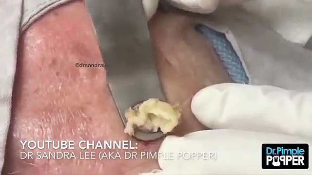 Il a cet énorme truc sur la tête depuis des années, la médecin le crève enfin. Ce qui sort de là? OH MON DIEU!