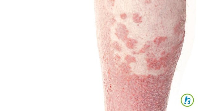 Types of Psoriasis Can Be Cured by New Drug