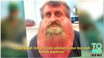 Pria Slovakia mengangkat tumor 6 kg dari lehernya - Tomonews