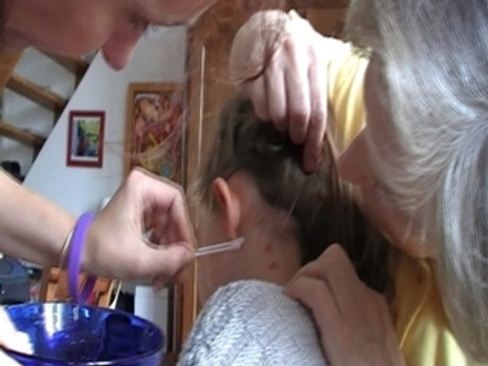Badijonage des boutons de varicelle de J-Lou