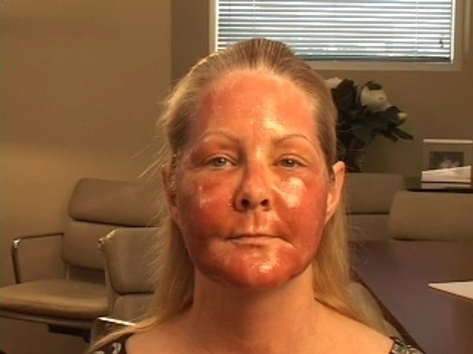 FAT GRAFTING DALLAS RHYTEC PORTRAIT PLASMA RECOVERY DALLAS