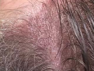 DALLAS HAIR TRANSPLANT:  MALE HAIRLINE VARIATION