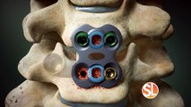 Barrow Brain and Spine offers minimally invasive spine surgery technique