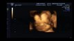 4D ultrasound scan at 26 weeks