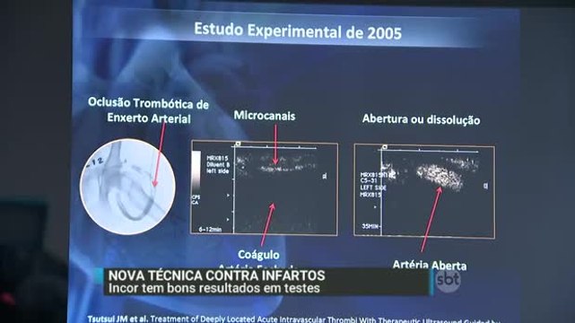 Nova técnica pode ajudar a salvar vítimas de infarto