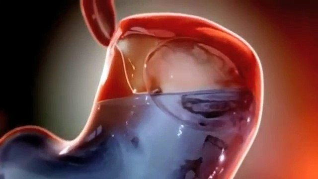 Obésité : Un ballon qui gonfle dans l’estomac pour perdre du poids