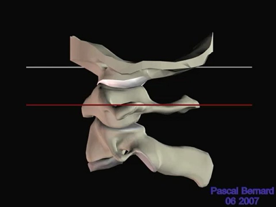 Flexion de C1 pendant rotation RCS