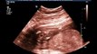 20 weeks ultrasound Dec 22, 2009 (Part 4)