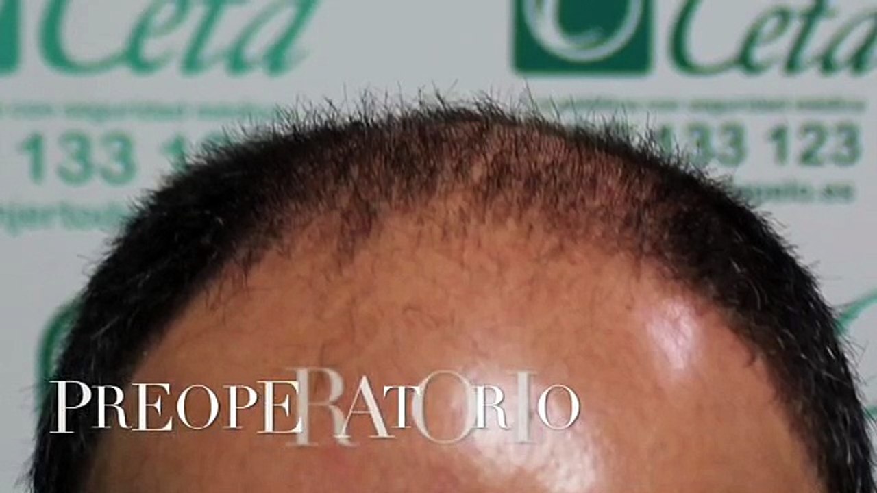 CLINICAS CETA CAPITAL www.injertodepelo.es