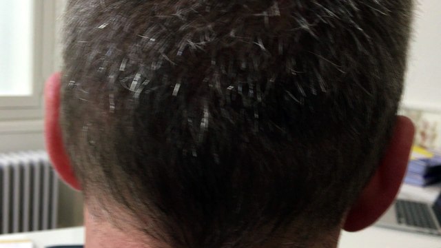 Zone doneuse 3 mois apres une greffe ARTAS The Clinic