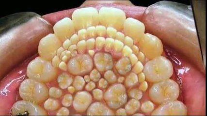 Doctors remove 232 TEETH from boy's MOUTH in a Record Breaking operation.