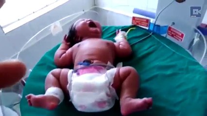 Une Indienne pèse 6,8 kilos à la naissance !